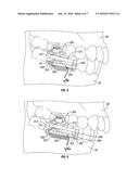 Mandibular repositioning device diagram and image