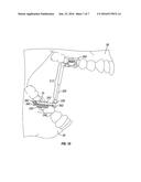 Mandibular repositioning device diagram and image