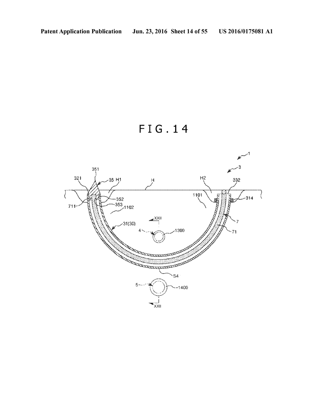 MEDICAL TUBE, MEDICAL DEVICE SET, AND METHOD OF PLACING IMPLANT INDWELLING - diagram, schematic, and image 15