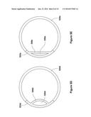 DEVICE FOR TREATING VASCULAR OCCLUSION diagram and image