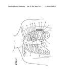 COLLAPSIBLE EXTRAVASCULAR LEAD diagram and image