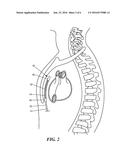 COLLAPSIBLE EXTRAVASCULAR LEAD diagram and image