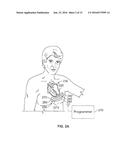 LEADLESS CARDIAC STIMULATION SYSTEMS diagram and image