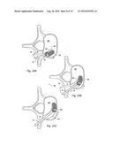 VARIABLE ANGLE SPINAL SURGERY INSTRUMENT diagram and image