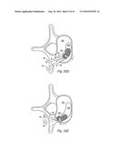 VARIABLE ANGLE SPINAL SURGERY INSTRUMENT diagram and image