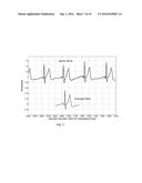 ELECTROCARDIOGRAM SIGNAL DETECTION diagram and image