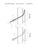 Vascular Closure Devices and Methods Providing Hemostatic Enhancement diagram and image