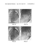 ATRIAL APPENDAGE LIGATION diagram and image