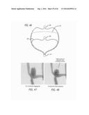 FILAMENTARY DEVICES FOR TREATMENT OF VASCULAR DEFECTS diagram and image