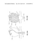 DEVICES FOR THERAPEUTIC VASCULAR PROCEDURES diagram and image