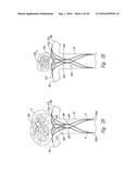 SYSTEMS AND METHODS FOR ENCLOSING AN ANATOMICAL OPENING diagram and image