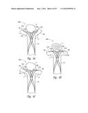 SYSTEMS AND METHODS FOR ENCLOSING AN ANATOMICAL OPENING diagram and image