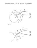 SYSTEMS AND METHODS FOR ENCLOSING AN ANATOMICAL OPENING diagram and image