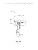 SYSTEMS AND METHODS FOR ENCLOSING AN ANATOMICAL OPENING diagram and image