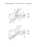 SYSTEMS AND METHODS FOR ENCLOSING AN ANATOMICAL OPENING diagram and image