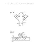 MULTIPLE LAYER FILAMENTARY DEVICES FOR TREATMENT OF VASCULAR DEFECTS diagram and image