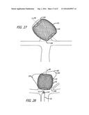 MULTIPLE LAYER FILAMENTARY DEVICES FOR TREATMENT OF VASCULAR DEFECTS diagram and image