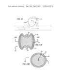 MULTIPLE LAYER FILAMENTARY DEVICES FOR TREATMENT OF VASCULAR DEFECTS diagram and image