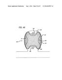 MULTIPLE LAYER FILAMENTARY DEVICES FOR TREATMENT OF VASCULAR DEFECTS diagram and image