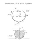 MULTIPLE LAYER FILAMENTARY DEVICES FOR TREATMENT OF VASCULAR DEFECTS diagram and image