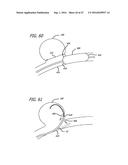 MULTIPLE LAYER FILAMENTARY DEVICES FOR TREATMENT OF VASCULAR DEFECTS diagram and image