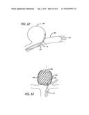 MULTIPLE LAYER FILAMENTARY DEVICES FOR TREATMENT OF VASCULAR DEFECTS diagram and image