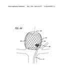 MULTIPLE LAYER FILAMENTARY DEVICES FOR TREATMENT OF VASCULAR DEFECTS diagram and image