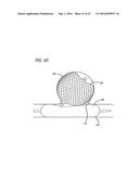 MULTIPLE LAYER FILAMENTARY DEVICES FOR TREATMENT OF VASCULAR DEFECTS diagram and image