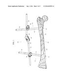 ORTHOPEDIC EXTERNAL FIXATION DEVICE diagram and image