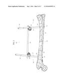 ORTHOPEDIC EXTERNAL FIXATION DEVICE diagram and image