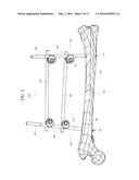 ORTHOPEDIC EXTERNAL FIXATION DEVICE diagram and image