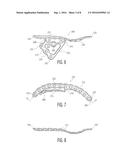 PELVIC BONE PLATE diagram and image