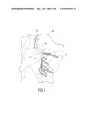 PELVIC BONE PLATE diagram and image