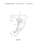 PELVIC BONE PLATE diagram and image