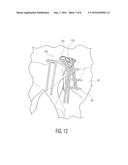 PELVIC BONE PLATE diagram and image