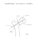 BONE FIXATION SCREW AND METHOD diagram and image