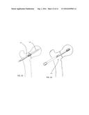 BONE FIXATION SCREW AND METHOD diagram and image