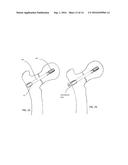 BONE FIXATION SCREW AND METHOD diagram and image