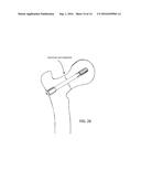 BONE FIXATION SCREW AND METHOD diagram and image