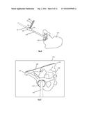 ALIGNMENT APPARATUS FOR USE IN HIP ARTHROPLASTY diagram and image