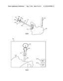 ALIGNMENT APPARATUS FOR USE IN HIP ARTHROPLASTY diagram and image