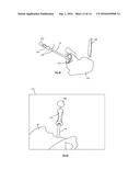 ALIGNMENT APPARATUS FOR USE IN HIP ARTHROPLASTY diagram and image