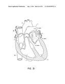 ENDOVASCULAR NEAR CRITICAL FLUID BASED CRYOABLATION CATHETER HAVING     SUPERELASTIC TREATMENT SECTION diagram and image