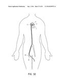 ENDOVASCULAR NEAR CRITICAL FLUID BASED CRYOABLATION CATHETER HAVING     SUPERELASTIC TREATMENT SECTION diagram and image