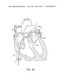 ENDOVASCULAR NEAR CRITICAL FLUID BASED CRYOABLATION CATHETER HAVING     SUPERELASTIC TREATMENT SECTION diagram and image