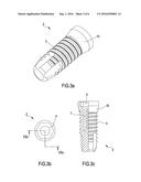 Dental Implant diagram and image