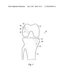 SUPPORT ASSEMBLY FOR A REPLACEMENT LIGAMENT AND ASSOCIATED METHOD diagram and image