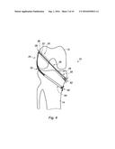 SUPPORT ASSEMBLY FOR A REPLACEMENT LIGAMENT AND ASSOCIATED METHOD diagram and image