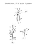 SUPPORT ASSEMBLY FOR A REPLACEMENT LIGAMENT AND ASSOCIATED METHOD diagram and image