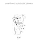 SUPPORT ASSEMBLY FOR A REPLACEMENT LIGAMENT AND ASSOCIATED METHOD diagram and image